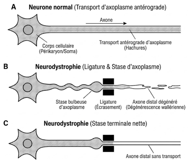 Neurodystrophie consécutive à une Stase d'axoplasme lors d'une ligature d'axone